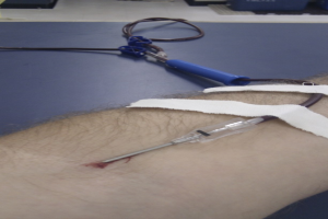 Die Hand einer Person mit einem Kochsalzschlauch und einer Nadel sowie mehreren Pflastern auf der Haut.